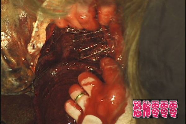 血胎(Fetus)